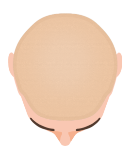 Full Lace System Full Lace System