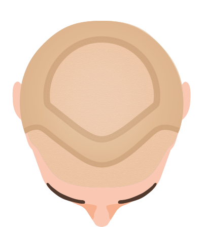 Lace Front System Lace Front System